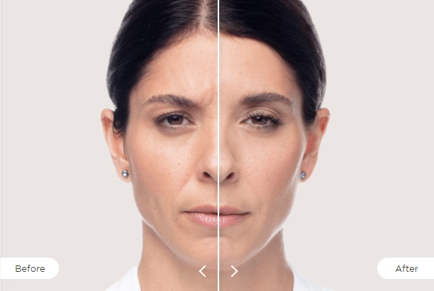 Dysport Before and After 1